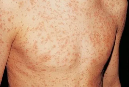 Allergiás bőrkiütés okok és a kezelés