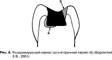 Класификация на зъбен кариес