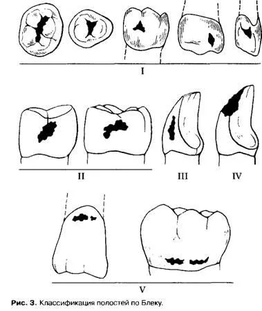 Clasificarea cariilor dentare