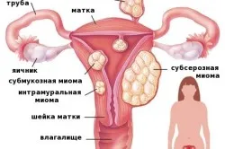 Лечение на подслизистата миома на матката