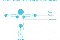 лечение на прекомерно потене (хиперхидроза)