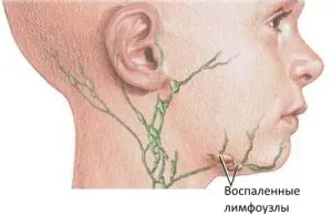 Lymphadenitis - besorolás, nyirokcsomó-gyulladás tünetei és kezelések