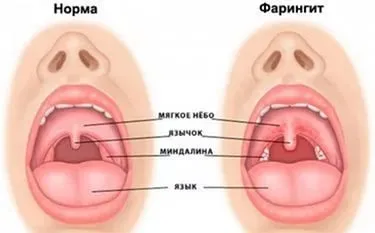 Tratamentul faringita la copii, cauzele sale și simptome