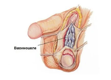 Laparoszkópos varicocele megelőzésére és kezelésére