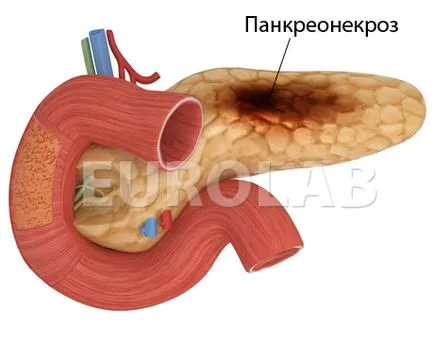 Tratamentul necrozei pancreatice - portalul medical EUROLAB