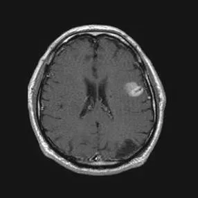 Imagistica prin rezonanta magnetica in diagnosticul diferential de accident vascular cerebral ischemic ..., publicat în