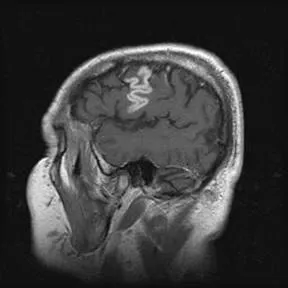 Магнитен резонанс в диференциалната диагноза на исхемичен мозъчен инсулт ..., публикуван в