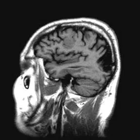 Mágneses rezonancia képalkotás differenciál diagnosztikájában az ischaemiás stroke ... kiadású