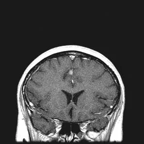 Imagistica prin rezonanta magnetica in diagnosticul diferential de accident vascular cerebral ischemic ..., publicat în