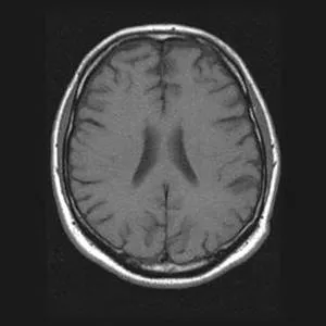 Imagistica prin rezonanta magnetica in diagnosticul diferential de accident vascular cerebral ischemic ..., publicat în