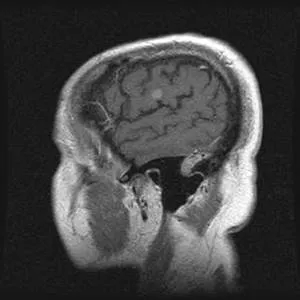 Mágneses rezonancia képalkotás differenciál diagnosztikájában az ischaemiás stroke ... kiadású