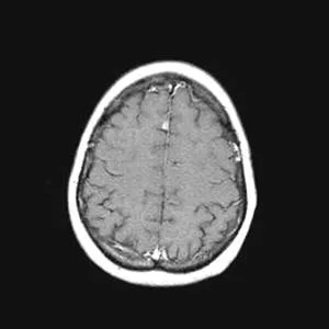 Imagistica prin rezonanta magnetica in diagnosticul diferential de accident vascular cerebral ischemic ..., publicat în