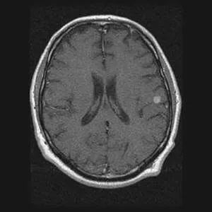 Imagistica prin rezonanta magnetica in diagnosticul diferential de accident vascular cerebral ischemic ..., publicat în