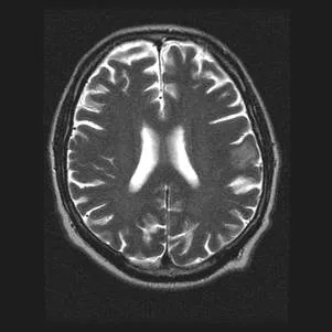 Imagistica prin rezonanta magnetica in diagnosticul diferential de accident vascular cerebral ischemic ..., publicat în