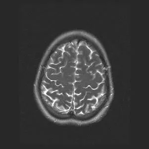 Магнитен резонанс в диференциалната диагноза на исхемичен мозъчен инсулт ..., публикуван в
