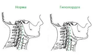 Lordosis a nyaki gerinc kezelésére, a tünetek, okok