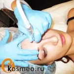 Microdermabraziunea (peeling diamant) fotografii cu probleme de piele, de revizuire - blogul femeii asupra sănătății și frumuseții