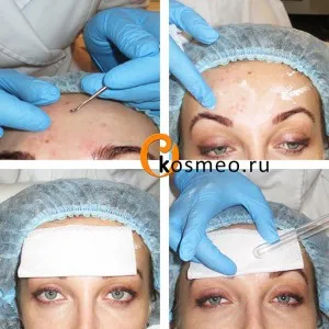 Microdermabraziunea (peeling diamant) fotografii cu probleme de piele, de revizuire - blogul femeii asupra sănătății și frumuseții