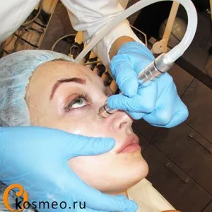 Microdermabraziunea (peeling diamant) fotografii cu probleme de piele, de revizuire - blogul femeii asupra sănătății și frumuseții