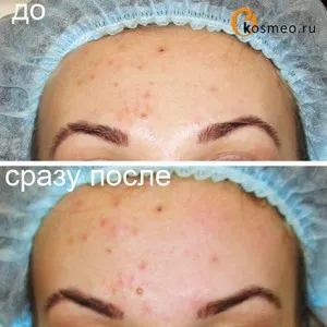 Mikrodermabrázió (gyémánt peeling) bőr probléma fotók, áttekintés - Női blog egészség és szépség