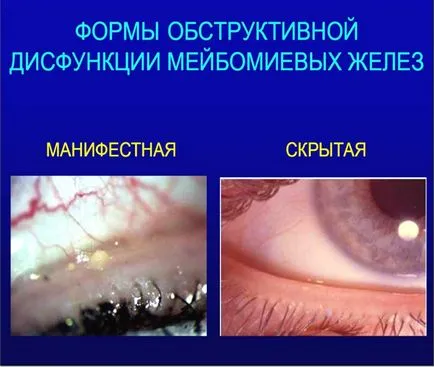 Слъзната блефарит снимка, симптоми, лечение и превенция