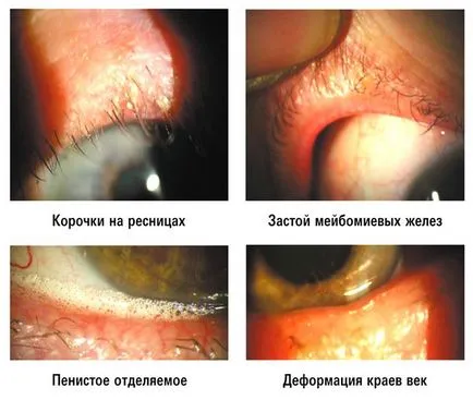 Слъзната блефарит снимка, симптоми, лечение и превенция