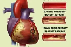 Има ли лечение сърдечна исхемия