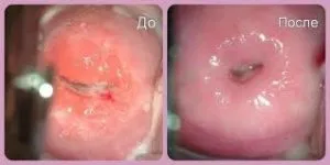 Este posibil de a planifica sarcina dupa cauterizare de eroziune