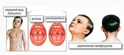 Mononucleosis felnőtteknél - tünetek kezelésére és megelőzésére