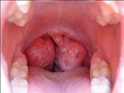 Mononucleosis felnőtteknél - tünetek kezelésére és megelőzésére