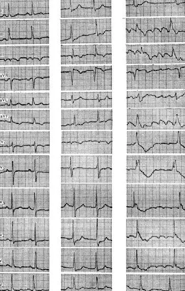 dezechilibru electrolitic - electrocardiogramei în unele boli și sindroame -