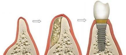 Csontaugmentáció beültetése előtt fogak, sinus lift érték és az ár Moszkva feltételeit