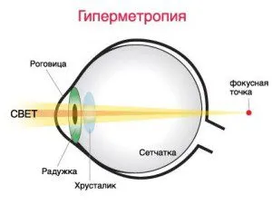 Hipermetropie la copii cauze, simptome, tratamente