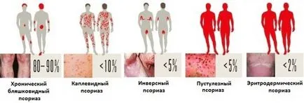 Хормонални китайска медицина за псориазис