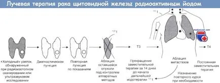 Non-Hodgkin a glandei tiroide - clinica, tratament