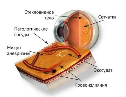 Complicațiile cu laser coagulării retiniene