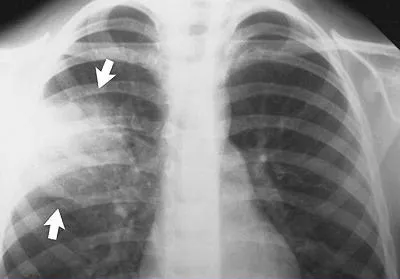 Caracteristici pneumonie cu raze X