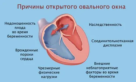 brevet foramen ovale în inima unui copil, nou-născut, pentru adulți