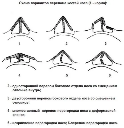 Счупен нос, тежестта на вредата, с отместване колко изцеление, кост