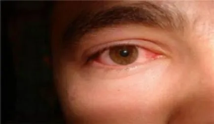 De ce ochii sunt în mod constant roșu întotdeauna după starea de veghe și somn