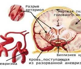 Защо умират от инсулт