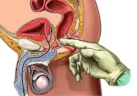 masaj de prostata este de a crește potența