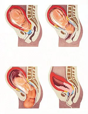 dezvăluirea prematură a colului uterin in timpul sarcinii, uterul in timpul sarcinii