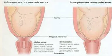 Преждевременно разкриване на шийката на матката по време на бременност, матката по време на бременност