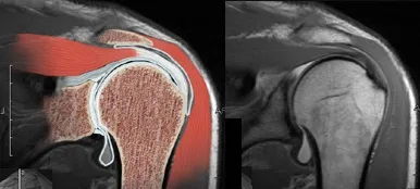 Slap kárt a labrum a vállízület