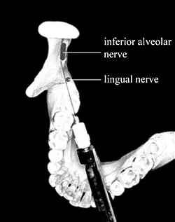 Причини и лечение на ятрогенни увреждане на нерв, когато упойката на долночелюстната