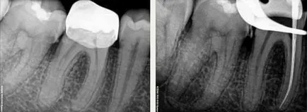 Az ultrahang használata endodoncia