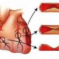 Contraindicații infarct miocardic - un bisturiu - informații medicale și educație