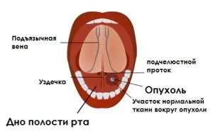 Рак на устната лигавица (лигавица, дъно, езика, бузите) симптоми и лечението като живо