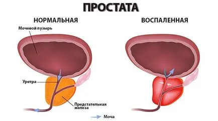 Prosztata Forte használati utasítást a gyógyszer